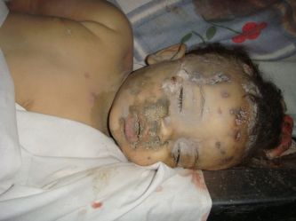 Dead Libyan Baby Fom…